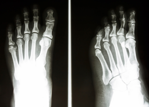 film X-ray show normal bone of human's foot