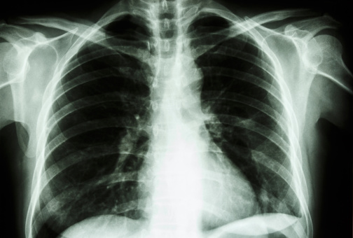 film X-ray show normal human's chest  (bone and internal organ)
