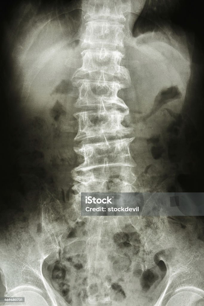 Curvada columna lumbar y la confianza de las personas de edad - Foto de stock de Anatomía libre de derechos