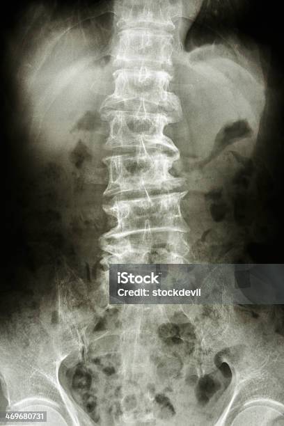 벤트 척추 및 스퍼스 이전 직원관리 X-레이에 대한 스톡 사진 및 기타 이미지 - X-레이, 골절, 배경-주제