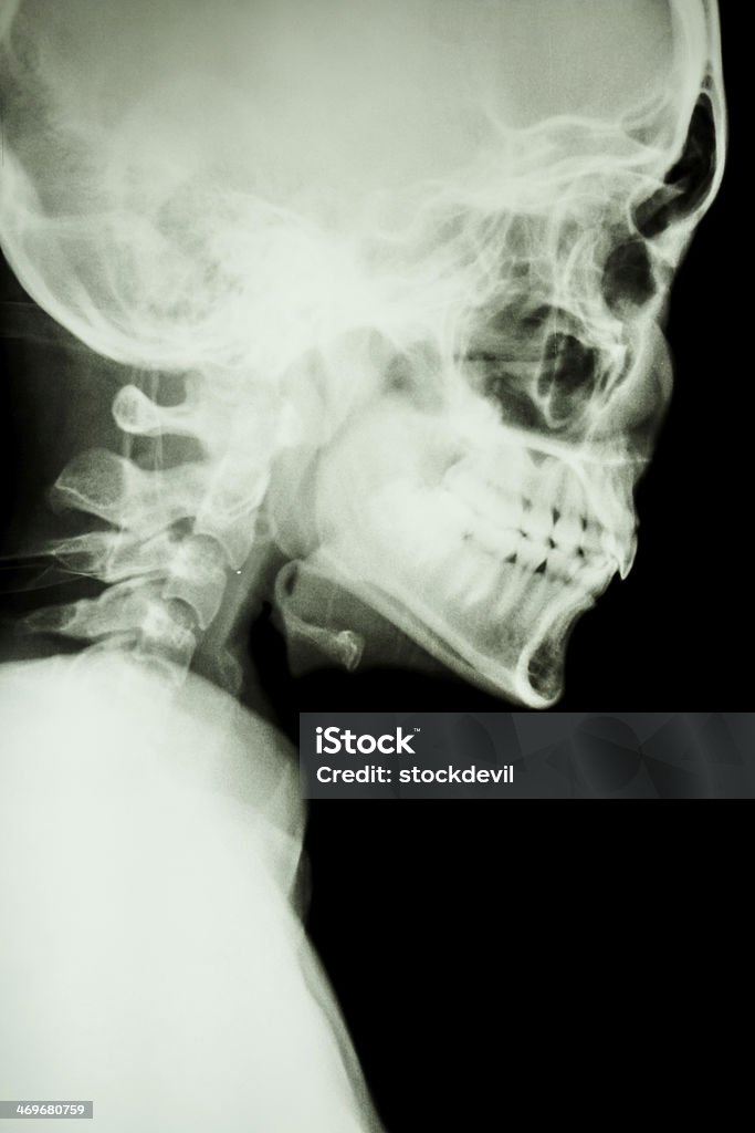 De crâne et de la colonne cervicale normale - Photo de Accident bénin libre de droits