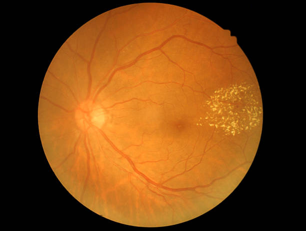 Medical photo of retinal and optic nerve Medical photo of retinal and optic nerve atrophy stock pictures, royalty-free photos & images