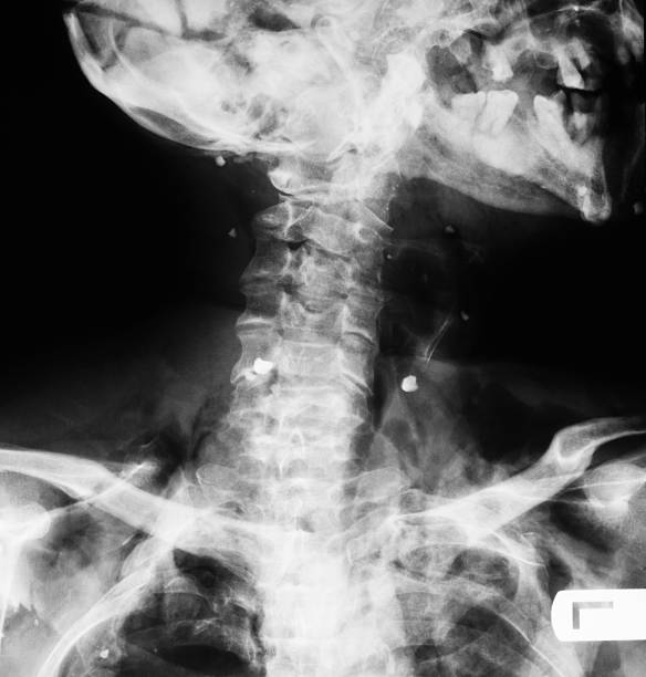 istock x-ray image of broken C-spine 469786616