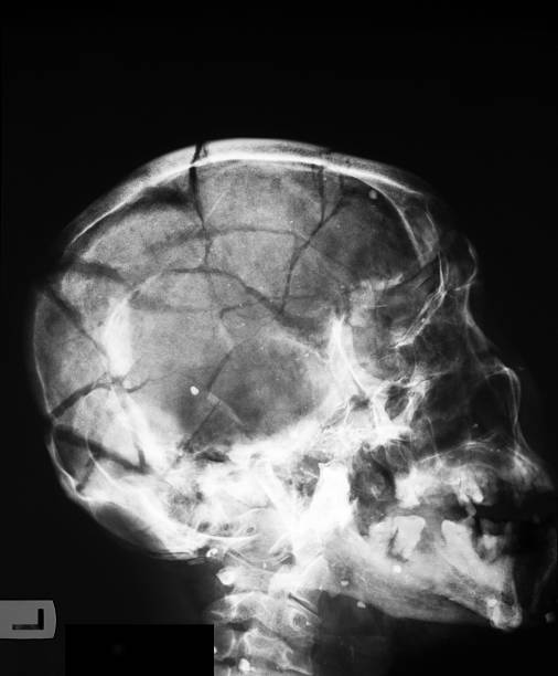 X-ray image of broken skull, lateral view X-ray image of broken skull, lateral view, the man hit by a truck bone fracture stock pictures, royalty-free photos & images