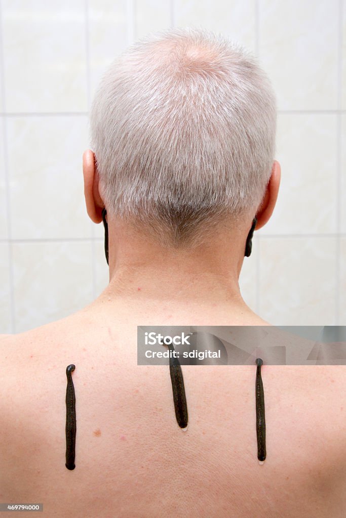 Leech therapy leech therapy for senior man 2015 Stock Photo