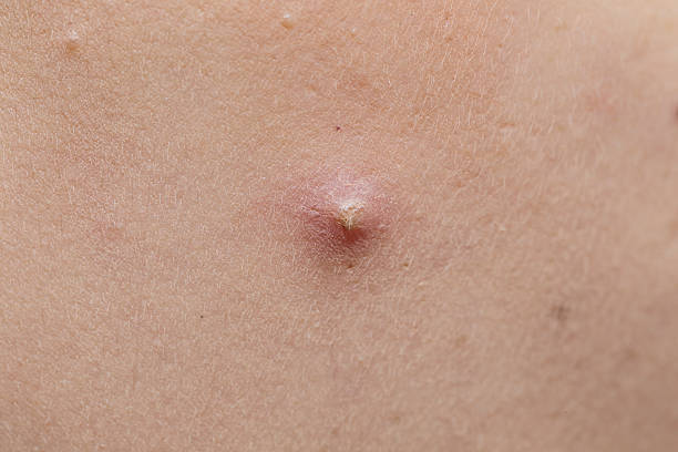 istock acne on woman face 469803226