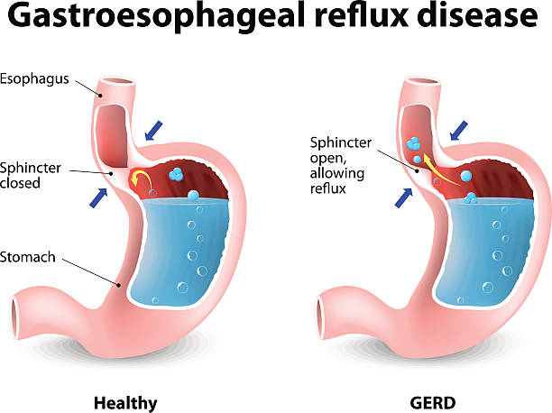 Gastroesophageal Reflux Disease Heartburn and Gastroesophageal Reflux Disease (GERD). The stomach releases strong acids to help break down the food. If the esophageal sphincter opens too often or does not close tight enough, stomach acid can reflux or seep back into the esophagus, damaging it and causing the burning (heartburn). sphincter stock illustrations