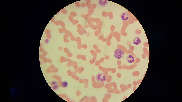 Plasmodium falciparum blood smear showing plasmodium falciparum malaria blood sample stock pictures, royalty-free photos & images
