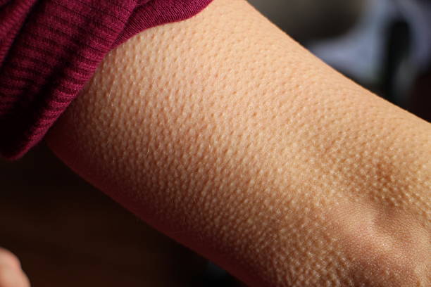 Skin Goosebumps Close-up