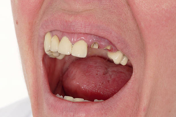 istock A close up of a mouth with broken teeth 470060678