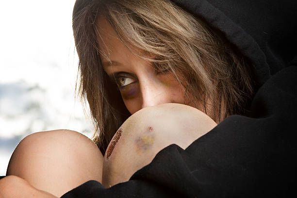 Sad Young Caucasian Woman at Great Risk with Black Eye Very angry and sad pretty young caucasian woman with brown hair and a troubled look on her face as she stares at the camera.  Her bare knee reveals a deep scab and a bruise from being abused.  This image depicts a young woman who is forced into human sex trafficking or something of equally bad results.  She has a black eye. people trafficking stock pictures, royalty-free photos & images