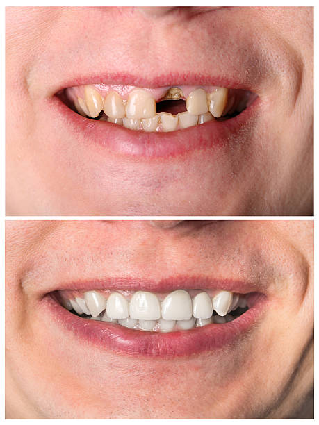 fuertes restauración dientes antes y después del tratamiento - dientes de animal fotografías e imágenes de stock