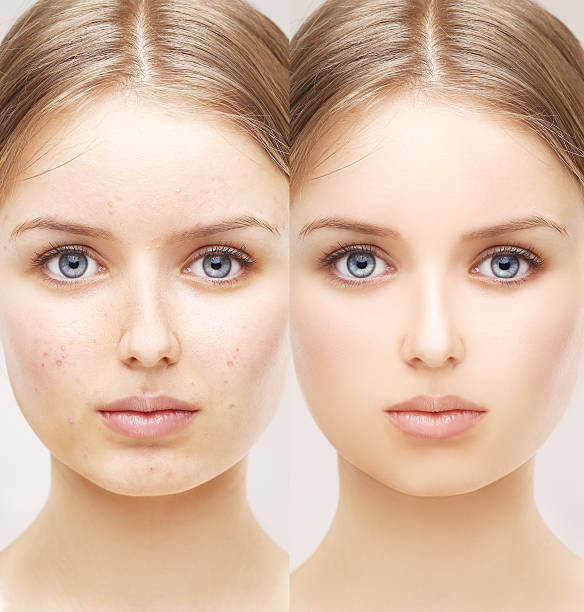 istock Girl with problem and clear skin. 470448282