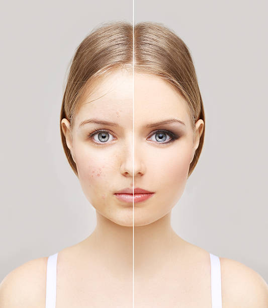 istock Girl with problem and clear skin. 470448300