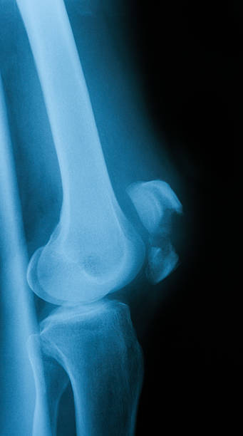 image au rayon x vue latérale de genou, - x ray human knee orthopedic equipment human bone photos et images de collection