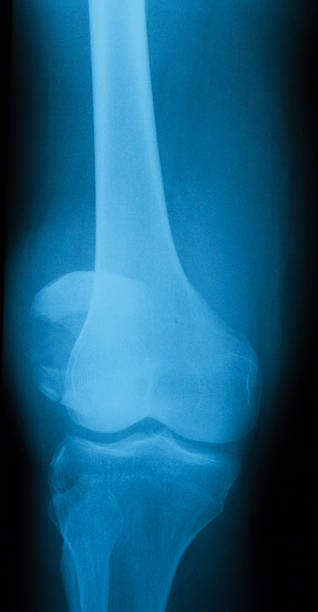 imagerie par rayons x de genou, vue sur l'aéroport - x ray human knee orthopedic equipment human bone photos et images de collection