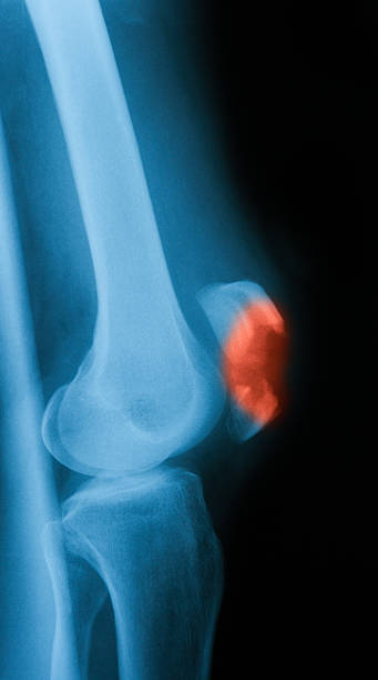imagerie par rayons x de broken genou, vue latérale - x ray human knee orthopedic equipment human bone photos et images de collection