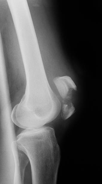 imagerie par rayons x d'articulation de genou, latral vue - x ray human knee orthopedic equipment human bone photos et images de collection