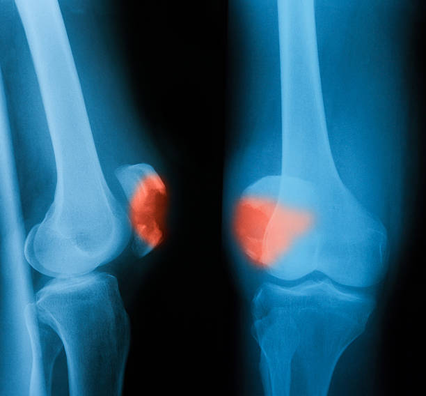 imagerie par rayons x de l'articulation du genou, ap et vue latérale - x ray human knee orthopedic equipment human bone photos et images de collection
