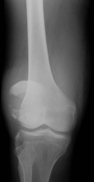imagerie par rayons x d'articulation de genou, vue sur l'aéroport - x ray human knee orthopedic equipment human bone photos et images de collection
