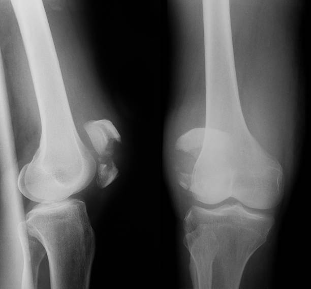 imagerie par rayons x de l'articulation du genou, ap et vue latérale - x ray human knee orthopedic equipment human bone photos et images de collection