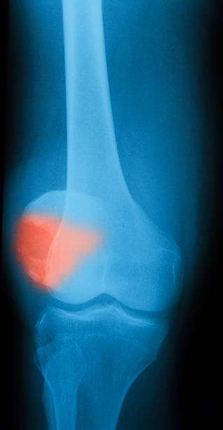 imagerie par rayons x de broken rotule, vue sur l'aéroport - x ray human knee orthopedic equipment human bone photos et images de collection