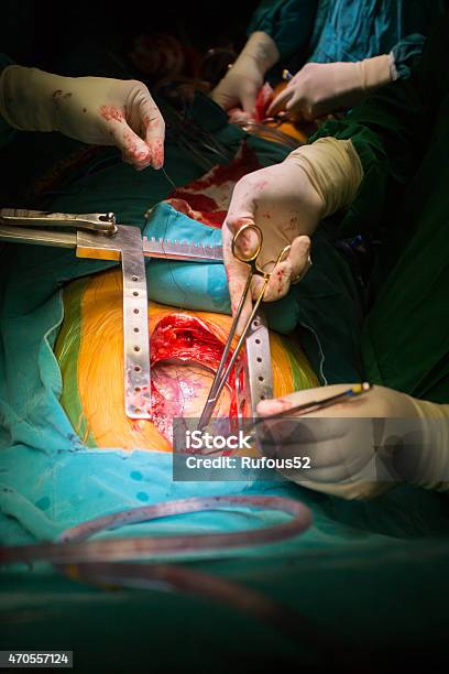Coronary Artery Bypass Grafting Stock Photo - Download Image Now - 2015, Aggression, Anesthetic