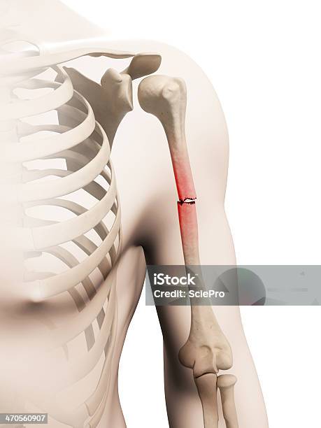 Braccio Rotto - Fotografie stock e altre immagini di Frattura - Frattura, Omero - Osso del braccio, Rotto