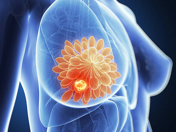 tumor de mama - cáncer tumor ilustraciones fotografías e imágenes de stock