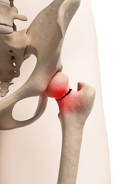 broken femur medical illustration of broken hip bone fracture stock pictures, royalty-free photos & images