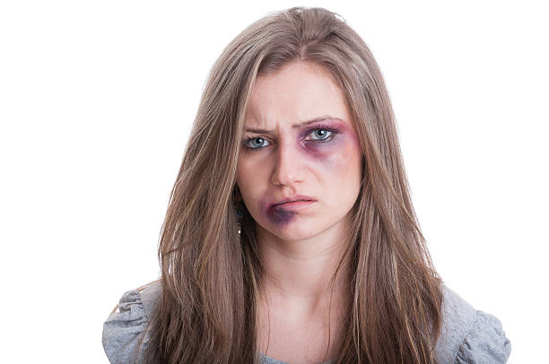 Injured woman with bruised eye stock photo