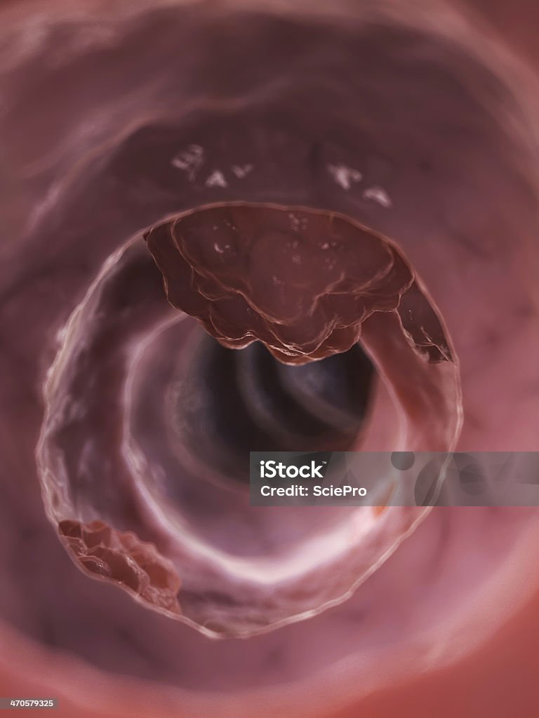 コロン腫瘍 - イラストレーションのロイヤリティフリーストックフォト