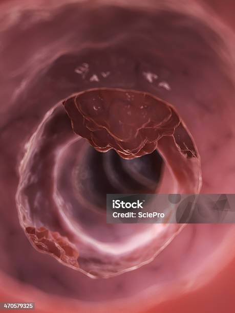 コロン腫瘍 - イラストレーションのストックフォトや画像を多数ご用意 - イラストレーション, コンピュータグラフィックス, ヒトの内臓