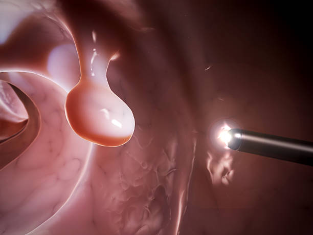 colonoscopy 3d rendered illustration of a colonoscopy colorectal cancer photos stock pictures, royalty-free photos & images