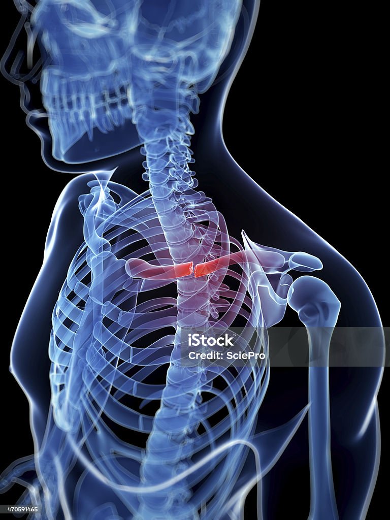 broken clavicle medical illustration of a broken clavicle Anatomy Stock Photo