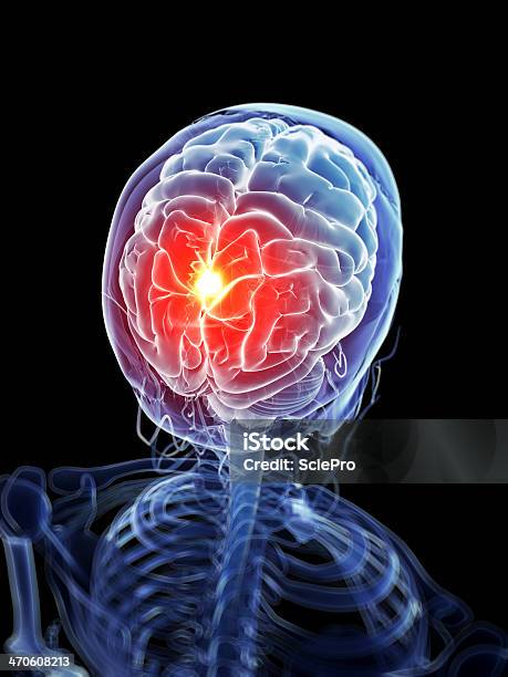 Головная Боль Иллюстрация — стоковые фотографии и другие картинки Анатомия - Анатомия, Биология, Болезнь