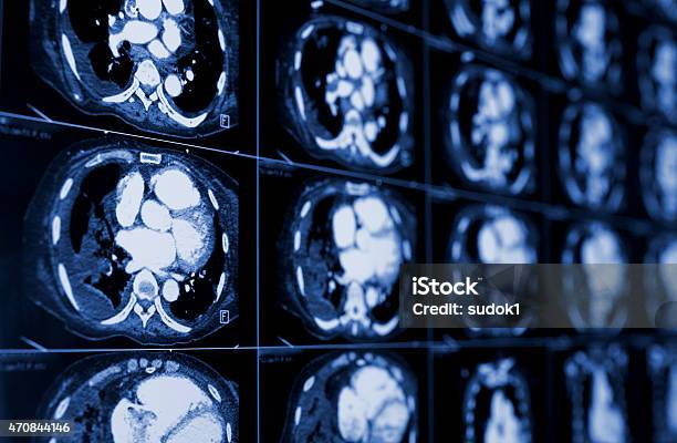 Computed Tomography Of The Chest Medical Background Stock Photo - Download Image Now