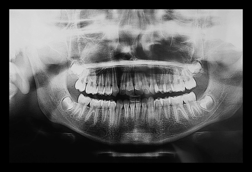 Medical X ray imaging of human skull, teeth and spine of a child