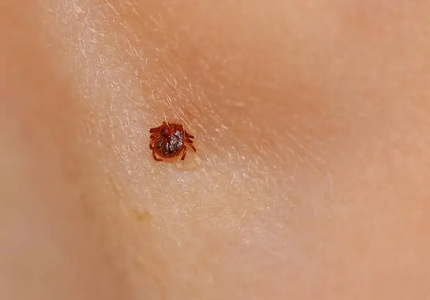 Photo of Blood sucking tick sitting on skin