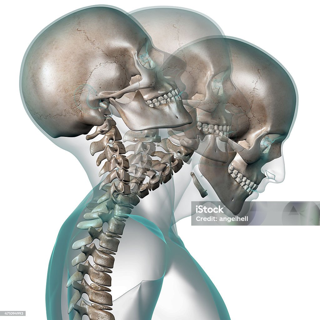 X-ray de Cabeça Humana com pescoço contortion - Foto de stock de Movimento Brusco da Cabeça para Trás royalty-free