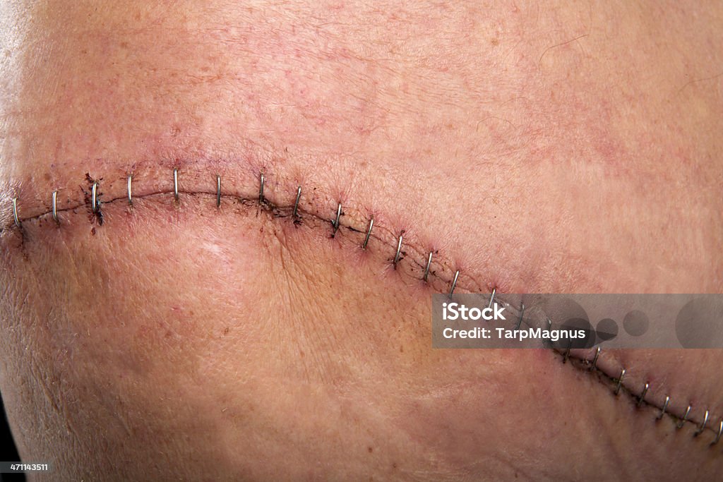 Chirurgie scar - Photo de Cicatrice libre de droits