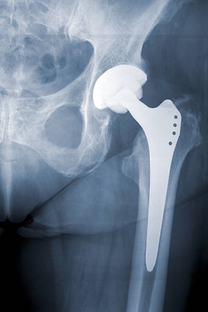 X-ray of an artificial left hip joint of a large human X-ray of a new Arthroplasty of the hip joint. (Abbreviation: HTP or H-TEP) from 2009 hip replacement stock pictures, royalty-free photos & images