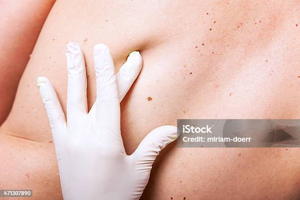 Skin Examination Of Moles Stock Photo - Download Image Now - Cancer - Illness, Medical Exam, Safety