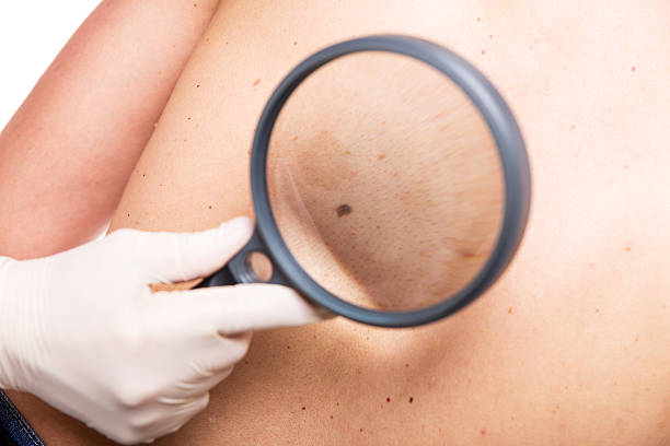 istock closeup of an skin examination 471321620