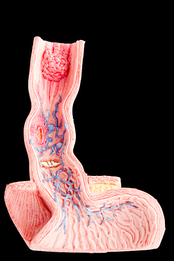 Anatomical model of a frontal section of the lower part of the oesophagus (or esophagus) from normal to columnar oesophageal epithelium.  Also part of the upper part of the stomach is shown. The model shows the following illnesses: reflux oesophagitis, ulcus, Barrett’s Ulcer, Oesophageal carcinoma, Oesophageal varices and hiatal hernia.  Black background. Studio shot.