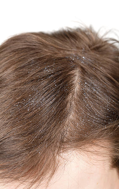 Dandruff Close up of dandruff dandruff stock pictures, royalty-free photos & images