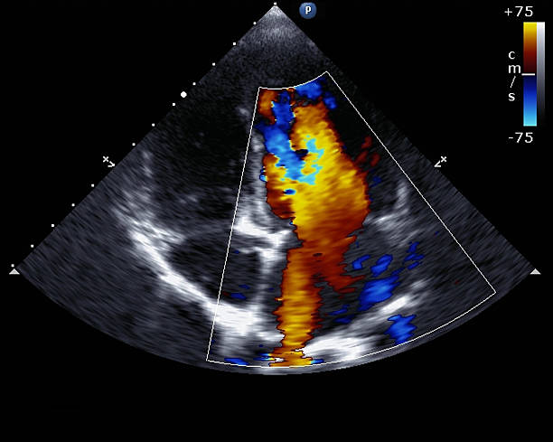 Doppler echocardiogram showing heat and cold spots Transthoracic two-dimensional color Doppler echocardiography aorta photos stock pictures, royalty-free photos & images