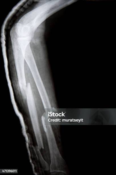骨折した腕でキャスト - 1人のストックフォトや画像を多数ご用意 - 1人, X線撮影, データ