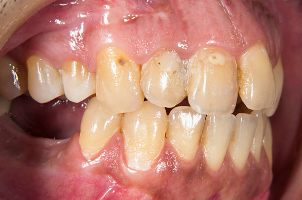 Gingivitis and multiple Caries stock photo