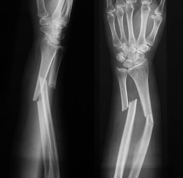 X-ray image of broken forearm, AP and lateral view X-ray image of forearm, AP and lateral view, show fracture of ulna and radius human arm stock pictures, royalty-free photos & images